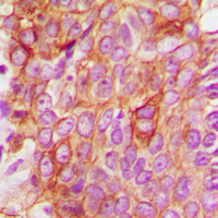 BAX Antibody - Immunohistochemical analysis of BAX staining in human breast cancer formalin fixed paraffin embedded tissue section. The section was pre-treated using heat mediated antigen retrieval with sodium citrate buffer (pH 6.0). The section was then incubated with the antibody at room temperature and detected using an HRP conjugated compact polymer system. DAB was used as the chromogen. The section was then counterstained with hematoxylin and mounted with DPX.