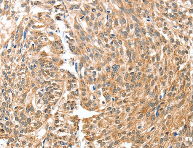 BAX Antibody - Immunohistochemistry of paraffin-embedded Human esophagus cancer using BAX Polyclonal Antibody at dilution of 1:30.