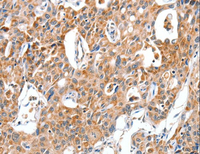 BAX Antibody - Immunohistochemistry of paraffin-embedded Human lung cancer using BAX Polyclonal Antibody at dilution of 1:30.