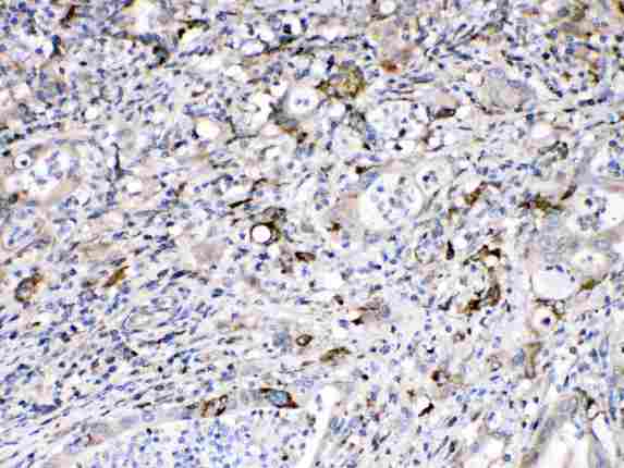 BAX Antibody - Bax was detected in paraffin-embedded sections of human intetsinal cancer tissues using rabbit anti- Bax Antigen Affinity purified polyclonal antibody