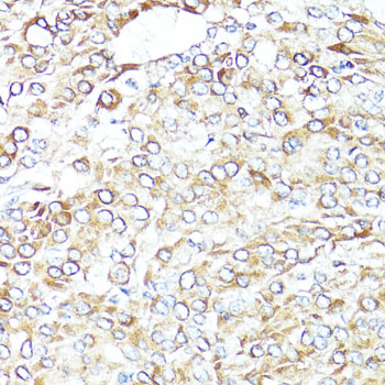 BAX Antibody - Immunohistochemistry of paraffin-embedded human lung cancer using BAX antibody at dilution of 1:100 (40x lens).