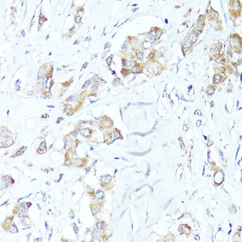 BAX Antibody - Immunohistochemistry of paraffin-embedded human mammary cancer using BAX antibody at dilution of 1:100 (40x lens).