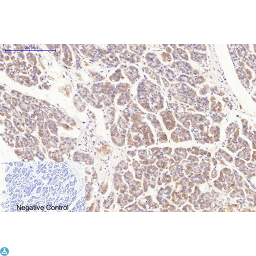 BAX Antibody - Immunohistochemical analysis of human stomach cancer tissue. Anti-Bax at 1:200 (4°C, overnight). Antigen retrieval - Sodium Citrate pH6 (>98°C, 20min). Secondary - 1:200 (room temp, 30min). Negative control - Secondary only