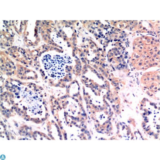 BAX Antibody - Immunohistochemistry (IHC) analysis of paraffin-embedded Human Breast Carcinoma Tissue using Bax Mouse monoclonal antibody diluted at 1:200.