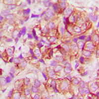 BAX Antibody - Immunohistochemical analysis of BAX staining in human lung cancer formalin fixed paraffin embedded tissue section. The section was pre-treated using heat mediated antigen retrieval with sodium citrate buffer (pH 6.0). The section was then incubated with the antibody at room temperature and detected using an HRP conjugated compact polymer system. DAB was used as the chromogen. The section was then counterstained with hematoxylin and mounted with DPX.