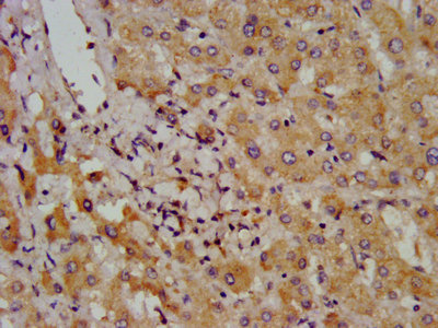 BAZ2B Antibody - IHC image of BAZ2B Antibody diluted at 1:800 and staining in paraffin-embedded human liver cancer performed on a Leica BondTM system. After dewaxing and hydration, antigen retrieval was mediated by high pressure in a citrate buffer (pH 6.0). Section was blocked with 10% normal goat serum 30min at RT. Then primary antibody (1% BSA) was incubated at 4°C overnight. The primary is detected by a biotinylated secondary antibody and visualized using an HRP conjugated SP system.