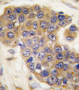 BBC3 / PUMA Antibody - Formalin-fixed and paraffin-embedded human breast carcinoma tissue reacted with Puma BH3 Domain antibody , which was peroxidase-conjugated to the secondary antibody, followed by DAB staining. This data demonstrates the use of this antibody for immunohistochemistry; clinical relevance has not been evaluated.