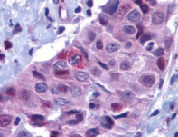 BBC3 / PUMA Antibody - Immunohistochemical staining of PUMA in human breast carcinoma with PUMA antibody at 10µg/ml.