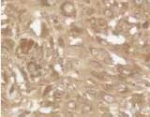 BBC3 / PUMA Antibody - PUMA expression in human dysplastic nevi (premalignant melanoma).