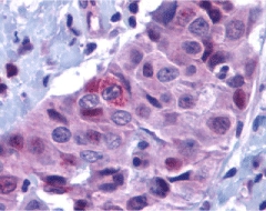 BBC3 / PUMA Antibody - Immunohistochemistry of PUMA in human breast carcinoma with PUMA antibody at 10 ug/ml.