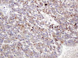 BBOX1 / BBOX Antibody - IHC of paraffin-embedded Carcinoma of Human liver tissue using anti-BBOX1 mouse monoclonal antibody. (Heat-induced epitope retrieval by 10mM citric buffer, pH6.0, 120°C for 3min).