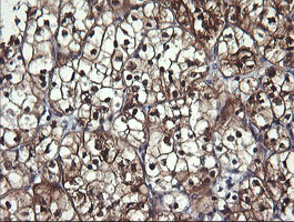 BBOX1 / BBOX Antibody - IHC of paraffin-embedded Carcinoma of Human kidney tissue using anti-BBOX1 mouse monoclonal antibody.