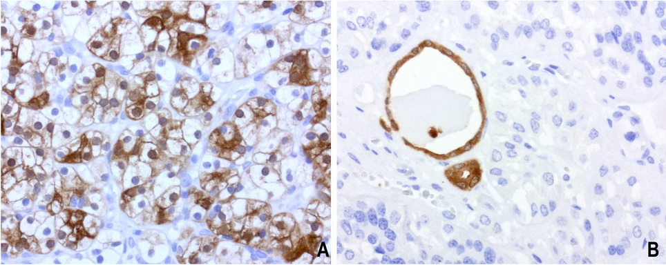 BBOX1 / BBOX Antibody - Immunohistochemical staining of paraffin-embedded human kidney carcinoma using anti-BBOX1 mouse monoclonal antibody at 1:200 dilution of 1.0 mg/mL using Polink2 Broad HRP DAB for detection.requires HIER with citrate pH6.0 at 110C for 3 min using pressure chamber/cooker. The composit image shows strong cytoplasmic, membrane, and nuclear in panel A tumor cells and no staining in panel B tumor cells but strong staining is normal tubule epithelial cells..