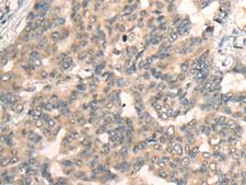 BBOX1 / BBOX Antibody - Immunohistochemistry of paraffin-embedded Human liver cancer tissue  using BBOX1 Polyclonal Antibody at dilution of 1:45(×200)