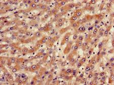 BBS10 Antibody - Immunohistochemistry of paraffin-embedded human liver cancer using BBS10 Antibody at dilution of 1:100
