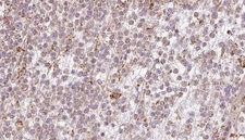 BBS10 Antibody - 1:100 staining human lymph carcinoma tissue by IHC-P. The sample was formaldehyde fixed and a heat mediated antigen retrieval step in citrate buffer was performed. The sample was then blocked and incubated with the antibody for 1.5 hours at 22°C. An HRP conjugated goat anti-rabbit antibody was used as the secondary.