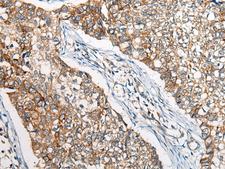 BBS12 Antibody - Immunohistochemistry of paraffin-embedded Human lung cancer tissue  using BBS12 Polyclonal Antibody at dilution of 1:50(×200)