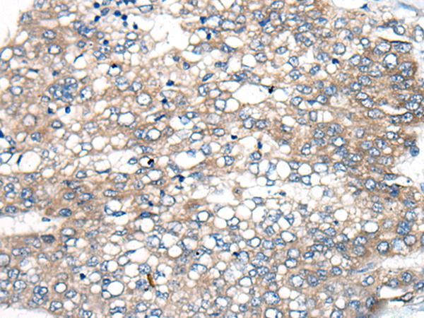 BBS12 Antibody - Immunohistochemistry of paraffin-embedded Human liver cancer tissue  using BBS12 Polyclonal Antibody at dilution of 1:50(×200)