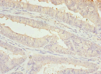 BBS2 / BBS Antibody - Immunohistochemistry of paraffin-embedded human endometrial cancer at dilution 1:100