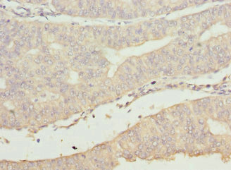BBS2 / BBS Antibody - Immunohistochemistry of paraffin-embedded human endometrial cancer at dilution 1:100