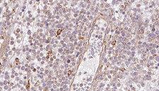 BBS4 Antibody - 1:100 staining human lymph carcinoma tissue by IHC-P. The sample was formaldehyde fixed and a heat mediated antigen retrieval step in citrate buffer was performed. The sample was then blocked and incubated with the antibody for 1.5 hours at 22°C. An HRP conjugated goat anti-rabbit antibody was used as the secondary.