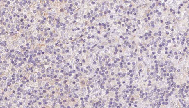 BBS7 Antibody - 1:100 staining human lymph carcinoma tissue by IHC-P. The sample was formaldehyde fixed and a heat mediated antigen retrieval step in citrate buffer was performed. The sample was then blocked and incubated with the antibody for 1.5 hours at 22°C. An HRP conjugated goat anti-rabbit antibody was used as the secondary.
