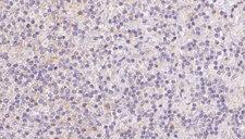 BBS7 Antibody - 1:100 staining human lymph carcinoma tissue by IHC-P. The sample was formaldehyde fixed and a heat mediated antigen retrieval step in citrate buffer was performed. The sample was then blocked and incubated with the antibody for 1.5 hours at 22°C. An HRP conjugated goat anti-rabbit antibody was used as the secondary.