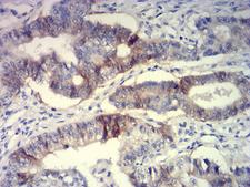 BCAM / CD239 Antibody - Immunohistochemical analysis of paraffin-embedded lung cancer tissues using CD239 mouse mAb with DAB staining.