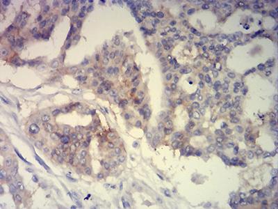 BCAM / CD239 Antibody - Immunohistochemical analysis of paraffin-embedded ovarian cancer tissues using CD239 mouse mAb with DAB staining.