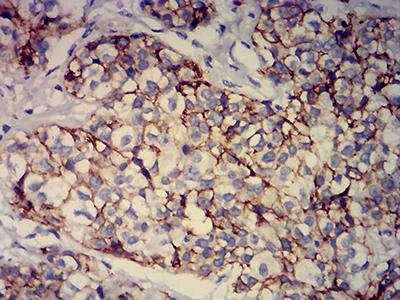 BCAM / CD239 Antibody - Immunohistochemical analysis of paraffin-embedded bladder cancer tissues using CD239 mouse mAb with DAB staining.