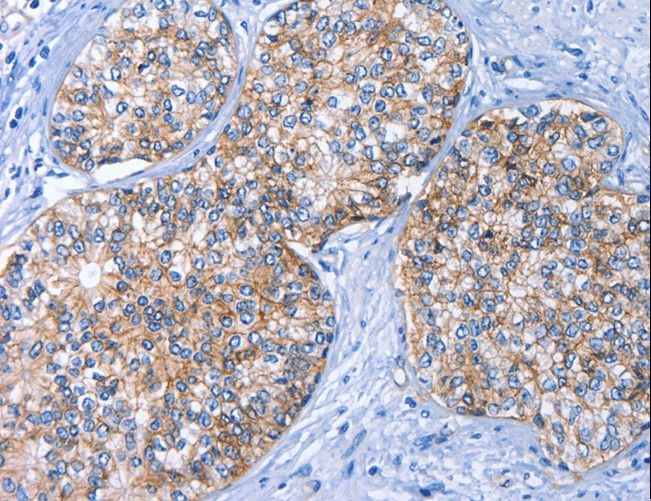 BCAM / CD239 Antibody - Immunohistochemistry of paraffin-embedded Human prostate cancer using BCAM Polyclonal Antibody at dilution of 1:40.