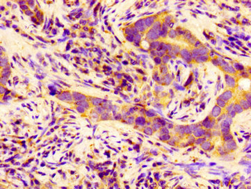 BCAM / CD239 Antibody - Immunohistochemistry image of paraffin-embedded human pancreatic cancer at a dilution of 1:100