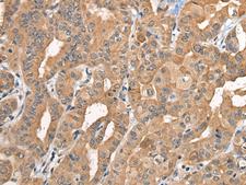 BCAN / Brevican Antibody - Immunohistochemistry of paraffin-embedded Human thyroid cancer tissue  using BCAN Polyclonal Antibody at dilution of 1:35(×200)