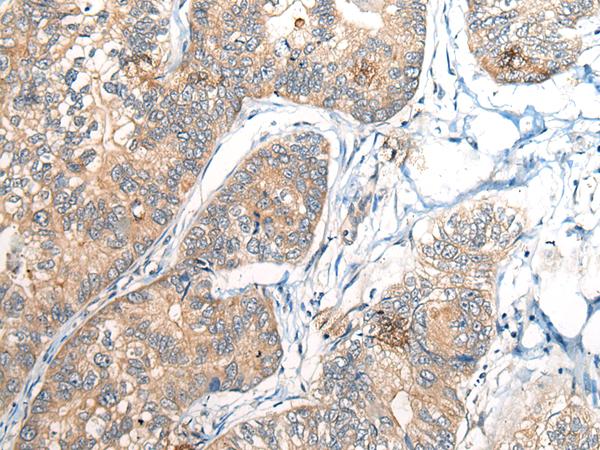 BCAN / Brevican Antibody - Immunohistochemistry of paraffin-embedded Human gastric cancer tissue  using BCAN Polyclonal Antibody at dilution of 1:35(×200)