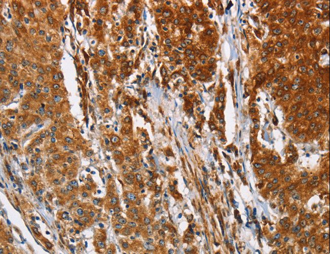 BCAP31 / BAP31 Antibody - Immunohistochemistry of paraffin-embedded Human gastric cancer using BCAP31 Polyclonal Antibody at dilution of 1:30.