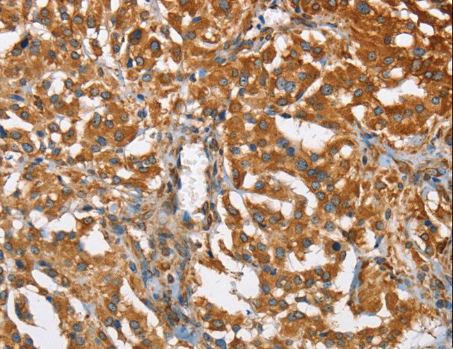 BCAP31 / BAP31 Antibody - Immunohistochemistry of paraffin-embedded Human thyroid cancer using BCAP31 Polyclonal Antibody at dilution of 1:30.