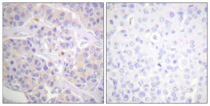 BCAR1 / p130Cas Antibody - Immunohistochemistry analysis of paraffin-embedded human breast carcinoma tissue, using p130 Cas Antibody. The picture on the right is blocked with the synthesized peptide.