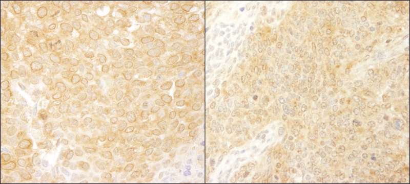 BCAR1 / p130Cas Antibody - Detection of Human and Mouse BCAR1/p130CAS by Immunohistochemistry. Sample: FFPE section of human breast carcinoma (left) and mouse teratoma (right). Antibody: Affinity purified rabbit anti-BCAR1/p130CAS used at a dilution of 1:200 (1 ug/ml).