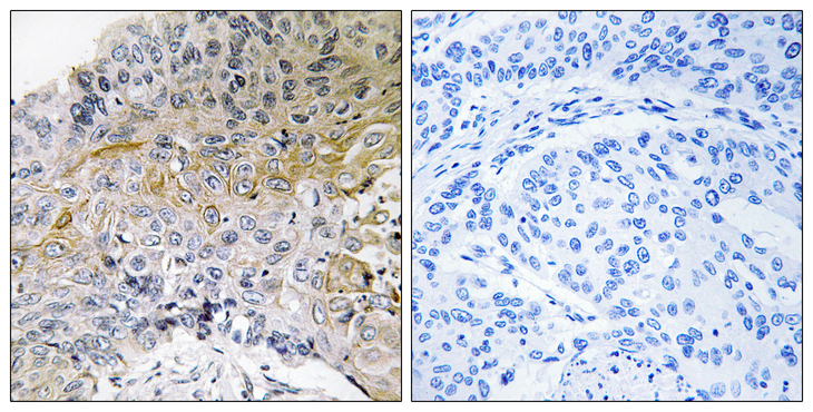 BCAR1 / p130Cas Antibody - Immunohistochemistry analysis of paraffin-embedded human breast carcinoma tissue, using p130 Cas Antibody. The picture on the right is blocked with the synthesized peptide.