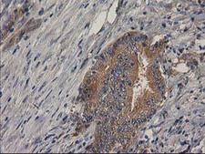 BCAR1 / p130Cas Antibody - IHC of paraffin-embedded Adenocarcinoma of Human colon tissue using anti-BCAR1 mouse monoclonal antibody. (Heat-induced epitope retrieval by 10mM citric buffer, pH6.0, 100C for 10min).