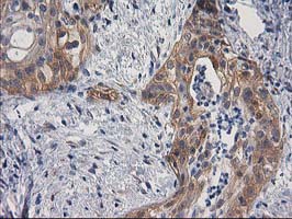 BCAR1 / p130Cas Antibody - IHC of paraffin-embedded Carcinoma of Human pancreas tissue using anti-BCAR1 mouse monoclonal antibody. (Heat-induced epitope retrieval by 10mM citric buffer, pH6.0, 100C for 10min).