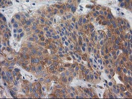 BCAR1 / p130Cas Antibody - IHC of paraffin-embedded Carcinoma of Human bladder tissue using anti-BCAR1 mouse monoclonal antibody. (Heat-induced epitope retrieval by 10mM citric buffer, pH6.0, 100C for 10min).