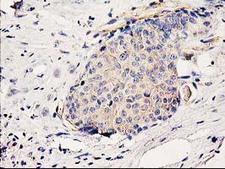 BCAR1 / p130Cas Antibody - IHC of paraffin-embedded Adenocarcinoma of Human breast tissue using anti-BCAR1 mouse monoclonal antibody.
