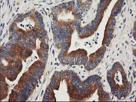 BCAR1 / p130Cas Antibody - IHC of paraffin-embedded Adenocarcinoma of Human colon tissue using anti-BCAR1 mouse monoclonal antibody.