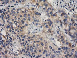 BCAR1 / p130Cas Antibody - IHC of paraffin-embedded Carcinoma of Human bladder tissue using anti-BCAR1 mouse monoclonal antibody.