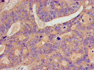 BCAR1 / p130Cas Antibody - Immunohistochemistry image of paraffin-embedded human colon cancer at a dilution of 1:100