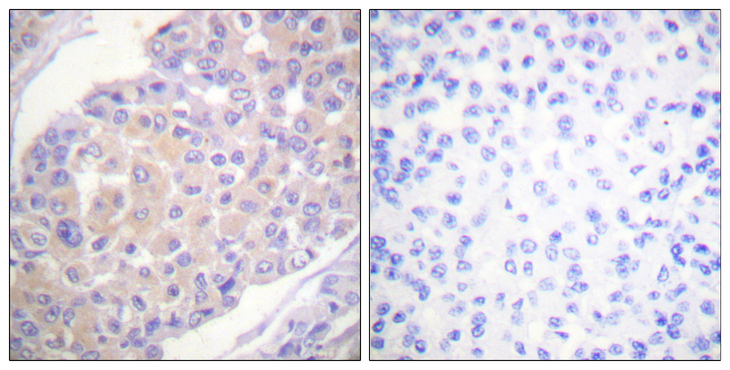 BCAR1 / p130Cas Antibody - Immunohistochemistry analysis of paraffin-embedded human breast carcinoma, using p130 Cas (Phospho-Tyr165) Antibody. The picture on the right is blocked with the phospho peptide.