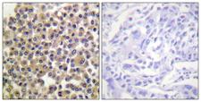 BCAR1 / p130Cas Antibody - Immunohistochemistry analysis of paraffin-embedded human breast carcinoma, using p130 Cas (Phospho-Tyr249) Antibody. The picture on the right is blocked with the phospho peptide.