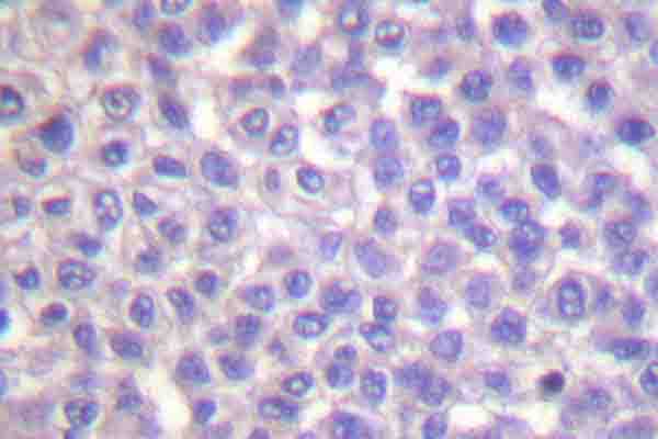 BCAR1 / p130Cas Antibody - Immunohistochemistry (IHC) analysis of p-p130 Cas (Y410) pAb in paraffin-embedded human lung cancer tissue.