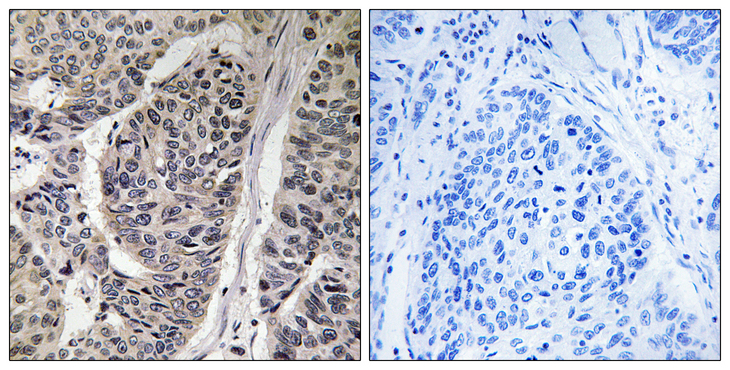 BCAR1 / p130Cas Antibody - Immunohistochemistry analysis of paraffin-embedded human breast carcinoma, using p130 Cas (Phospho-Tyr410) Antibody. The picture on the right is blocked with the phospho peptide.